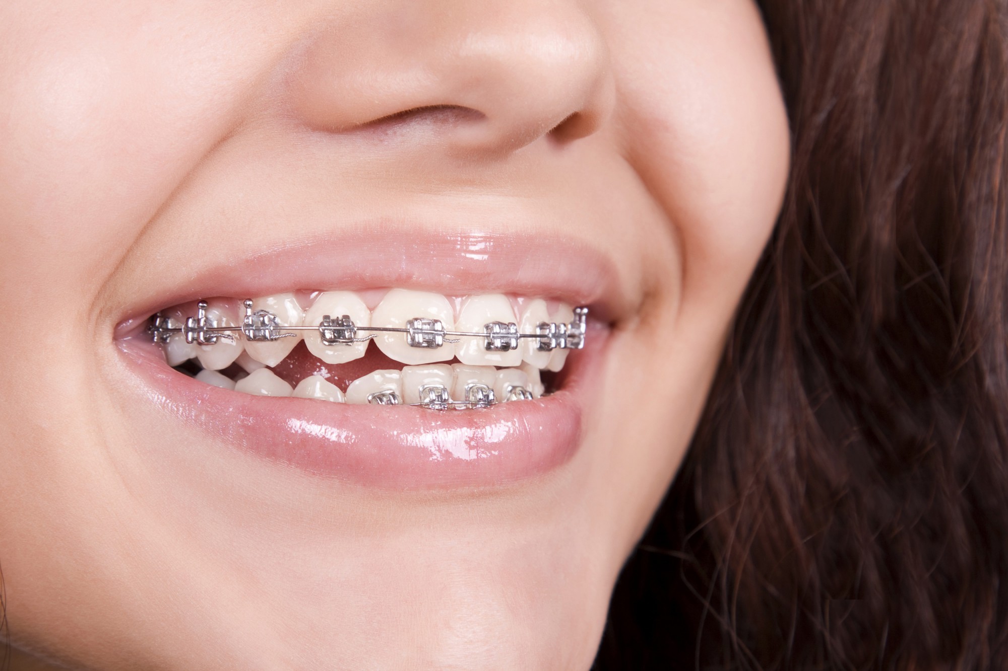 Braces Treatment